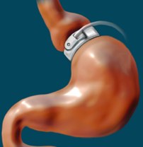 how does a gastric band work